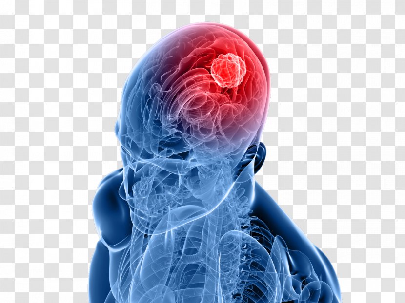 Gamma Knife Radiosurgery Cancer Brain Tumor Disease - Silhouette - Abnormal Transparent PNG