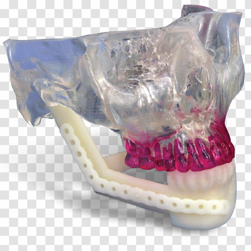 Mandible Jaw Mandibular Reconstruction Maxilla Surgery - 3d Printed Transparent PNG