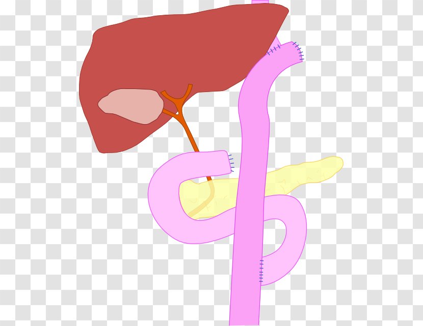 Sleeve Gastrectomy Roux-en-Y Anastomosis Gastric Bypass Surgery Billroth I - Watercolor - Cartoon Transparent PNG