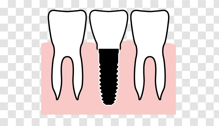 Tooth Gums Therapy Health Dental Implant - Silhouette Transparent PNG