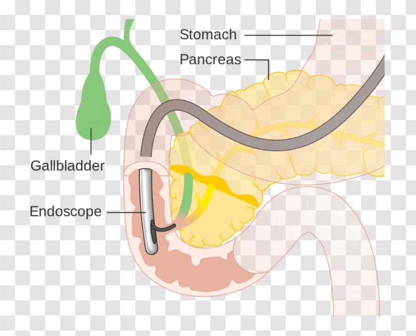 Endoscopic Retrograde Cholangiopancreatography Endoscopy Cholangiography Bile Duct Primary Sclerosing Cholangitis - Tree - Heart Transparent PNG