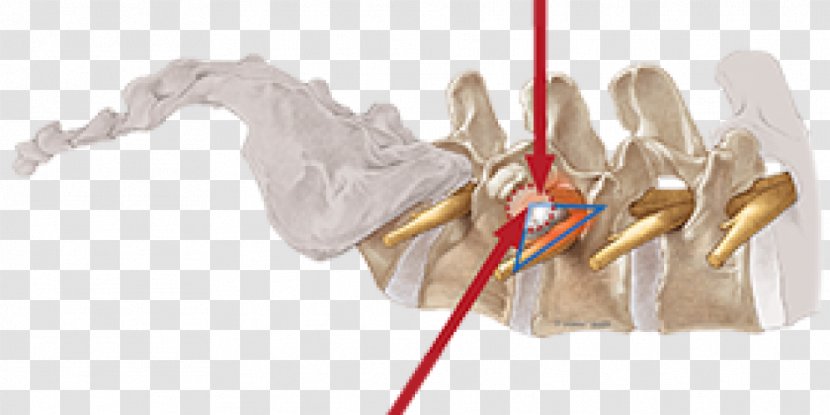 Vertebral Column Surgery Spinal Disc Herniation Endoscopy Intervertebral Foramen - Silhouette - Endoscopic Endonasal Transparent PNG