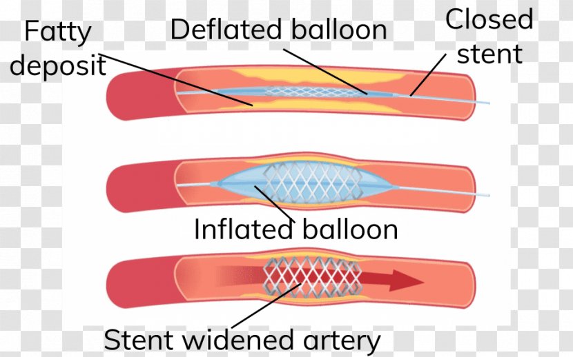 Angioplasty Heart Arteriosclerosis Artery Stenting - Text - Coronary Disease Transparent PNG