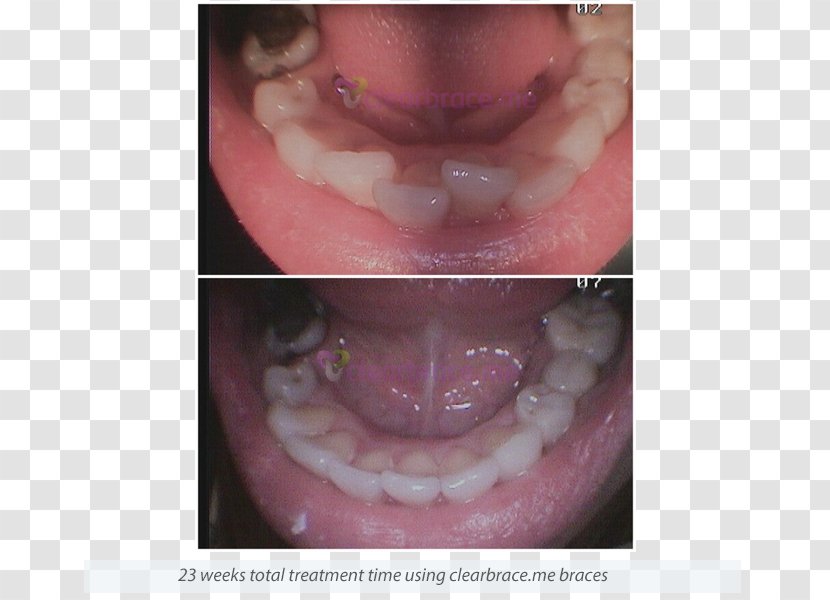 Tooth Dentures Close-up - Tongue - Lip Transparent PNG
