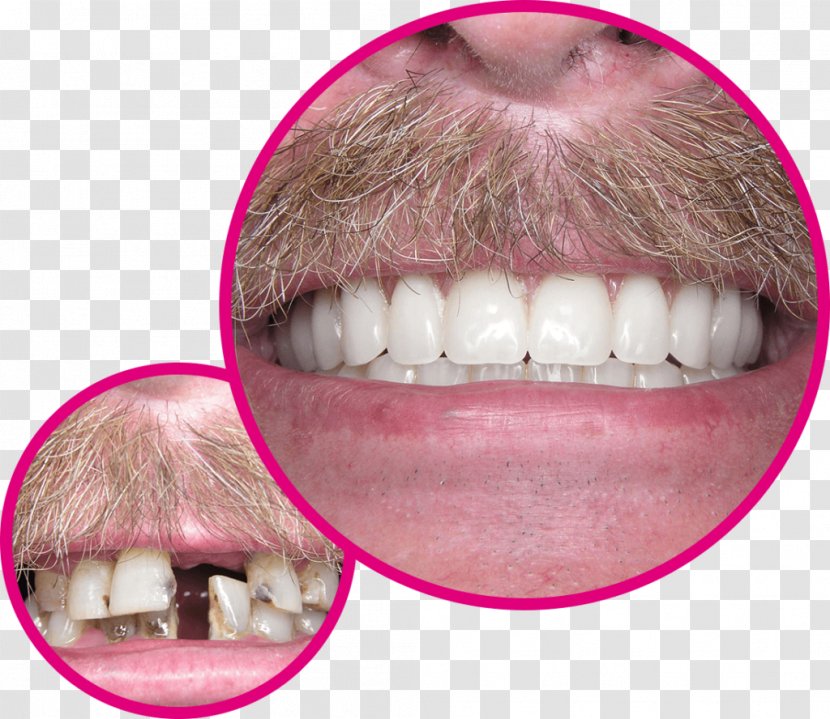 Human Tooth Dentures Dentist Implant - Gebiss - Crown Transparent PNG
