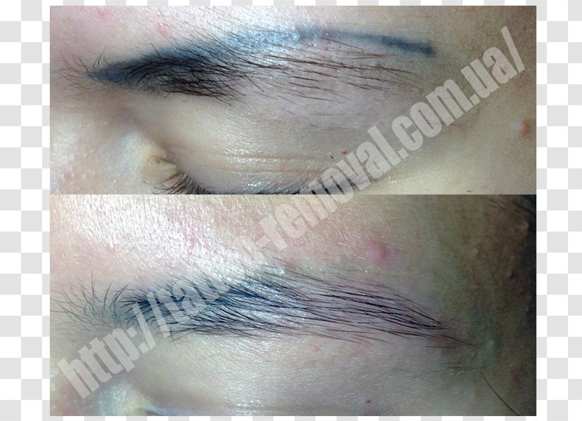 Tattoo Removal Permanent Makeup Scar Laser Transparent PNG