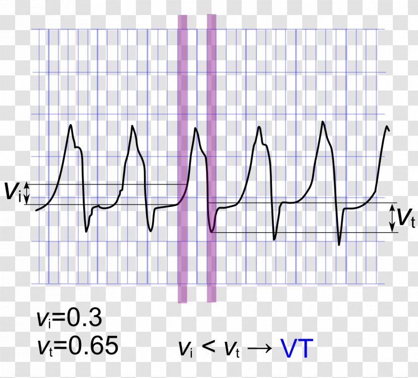 QRS Complex Ventricular Tachycardia Algorithm Bundle Branch Block Electrocardiography - Silhouette - Tree Transparent PNG