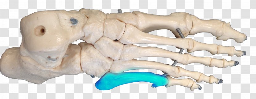 Jones Fracture Bone Metatarsal Bones Carolina Panthers Joint Transparent PNG