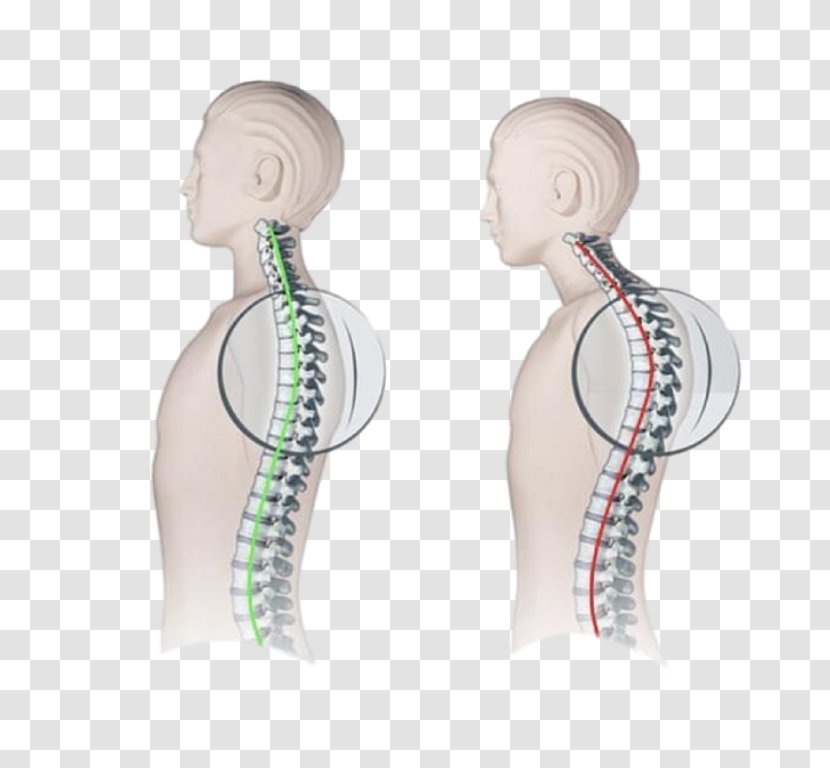 Kyphosis Vertebral Column Scoliosis Lordosis Scheuermann's Disease - Earrings Transparent PNG