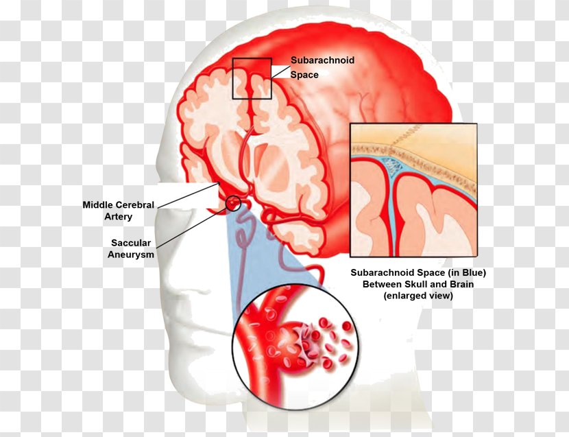 Blood Vessel Stroke Bleeding Brain - Heart Transparent PNG