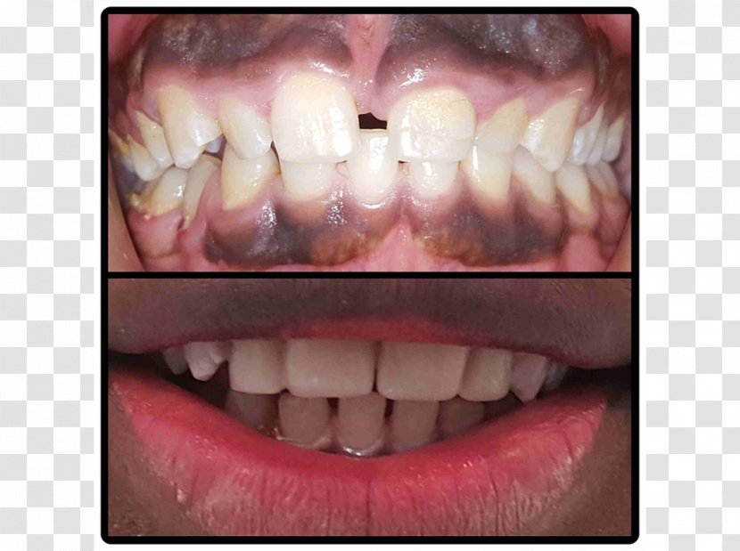 Tooth Veneer Dental Implant All-on-4 Dentistry - Crown Transparent PNG