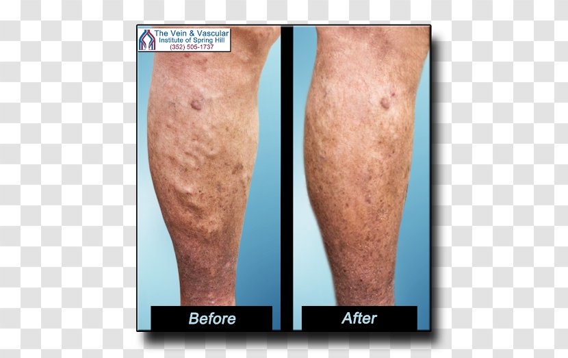 Varicose Veins Telangiectasia Endovenous Laser Treatment Sclerotherapy - Silhouette Transparent PNG