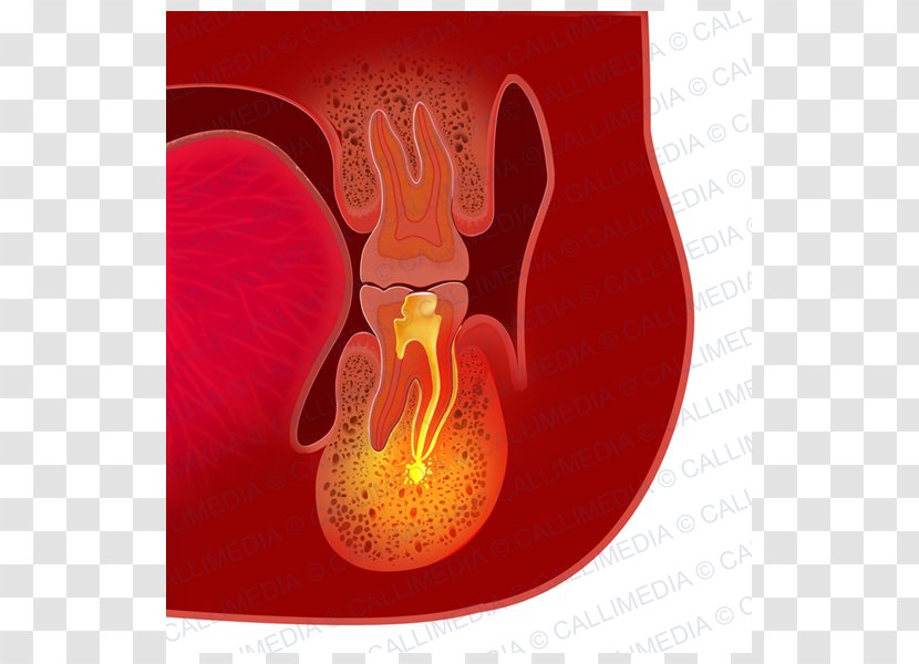 Dental Abscess Infection Periodontal Disease Tooth - Flower - Heart Transparent PNG