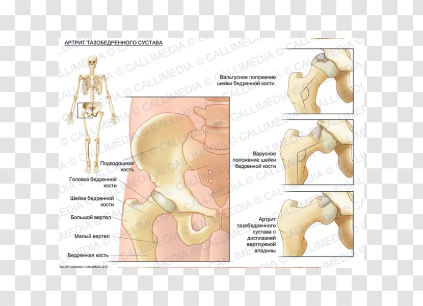 Hip Dysplasia Bone Arthritic Pain Femur - Flower - Arthritis Transparent PNG
