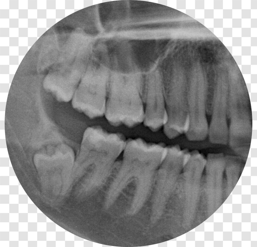 Wisdom Tooth Dental Extraction Jaw Trigeminal Nerve - Surgery Transparent PNG
