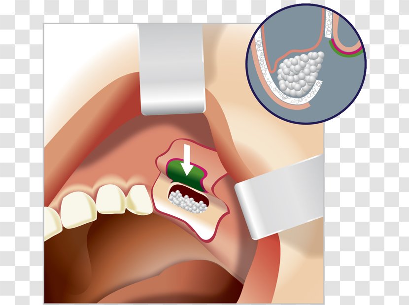 Sinus Lift Bone Grafting Implant Surgery - Cartoon Transparent PNG