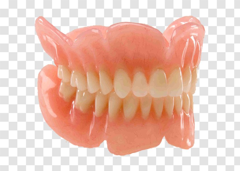 Dentures Dentistry Removable Partial Denture Prosthesis Dental Implant - Therapy - Bridge Transparent PNG