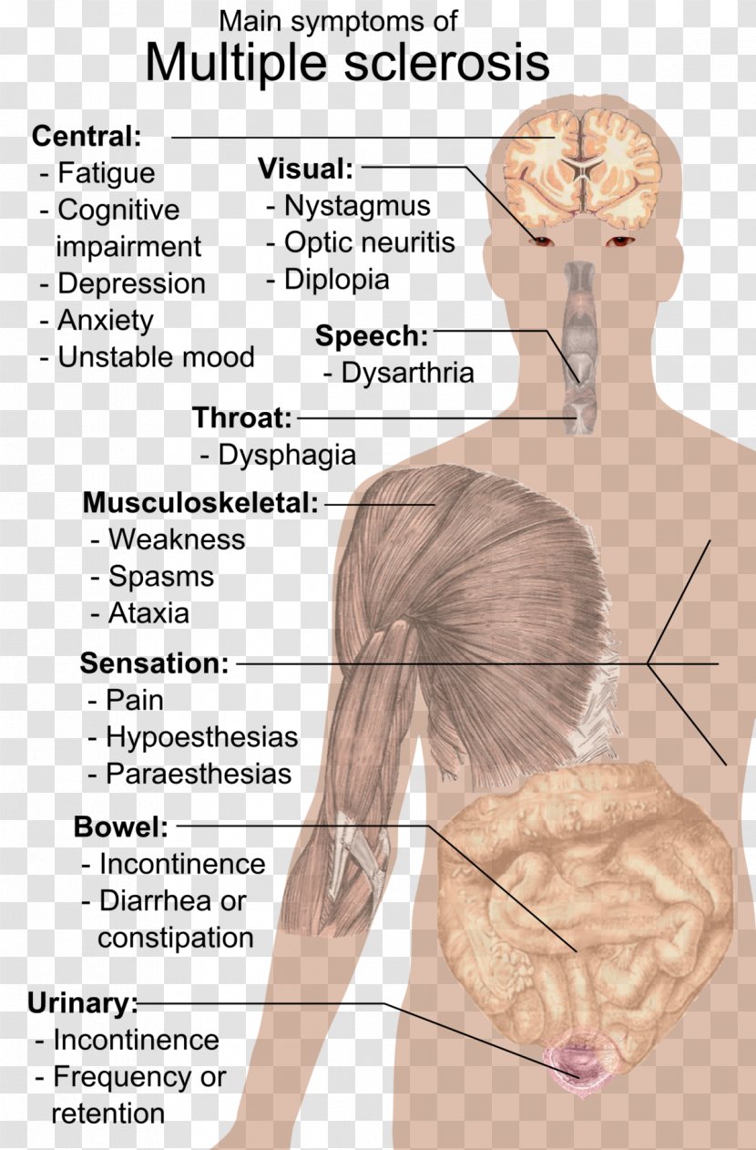 Multiple Sclerosis Signs And Symptoms Medical Sign Disease - Flower - Liver Human Transparent PNG