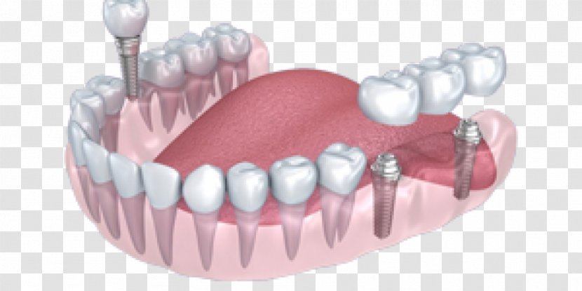 Tooth Dental Implant Dentistry Crown - Frame Transparent PNG