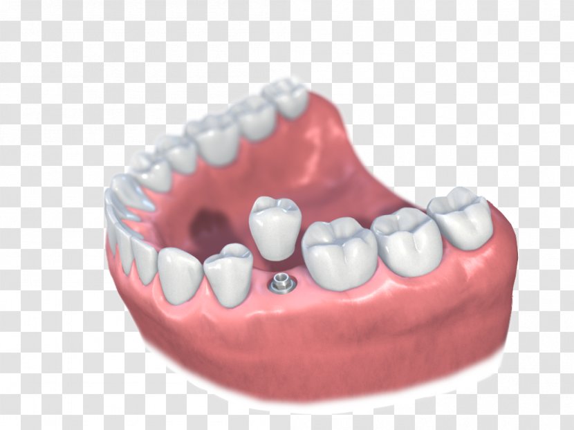 Dental Implant Dentistry Implantology Prosthesis - Tooth - Cabinet Transparent PNG