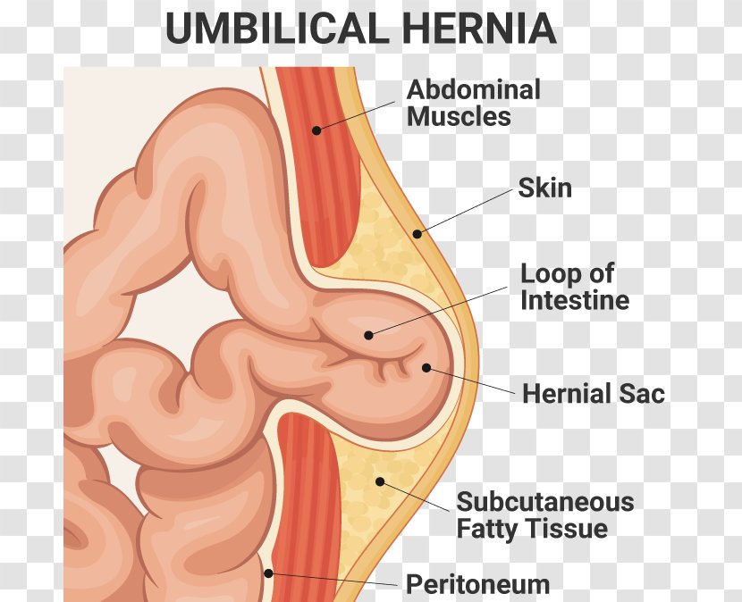 Umbilical Hernia Repair Inguinal Surgery - Frame - Flower Transparent PNG