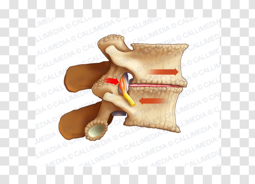 Osteoarthritis Lumbar Vertebrae Pain Arthrodesis Sciatica - Health Transparent PNG