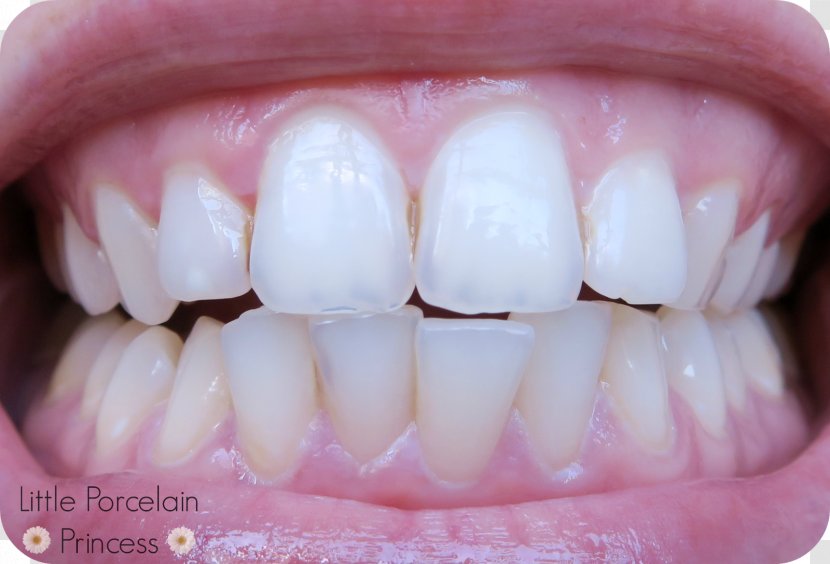 Tooth Whitening Gums Mouth Gel - Freckle Transparent PNG