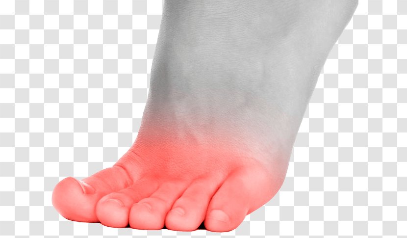 Toe Foot Ball Callus Disease - Cartoon - Gout Problems Transparent PNG