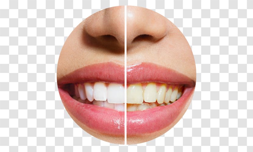 Lee And Van Mieghem DDS Cosmetic Dentistry Tooth Whitening - Decay - White Teeth Transparent PNG