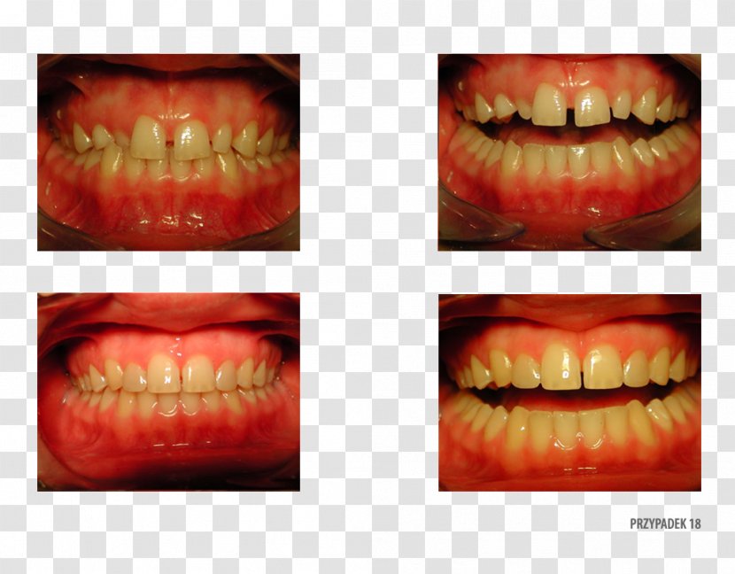 Gums Camera Gingivoplasty Ortoprotex Tooth - Smile Transparent PNG