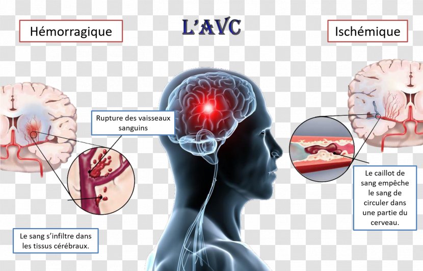 Stroke Transient Ischemic Attack Ischemia Stanley L. Goodman M.D. Disease - Tree - Cerveau Transparent PNG