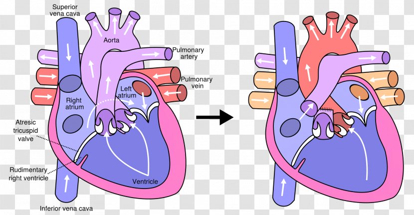Fontan Procedure Heart Surgery Tricuspid Atresia Pulmonary Artery - Tree - Neonatal Transparent PNG