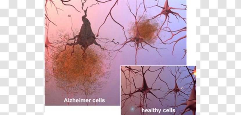 Alzheimer's Disease Association Brain Amyloid Beta Senile Plaques - Stock Photography Transparent PNG