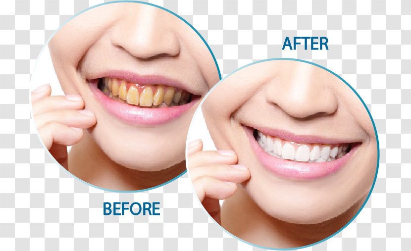 Cosmetic Dentistry Tooth Endodontics - Teeth Smile Transparent PNG