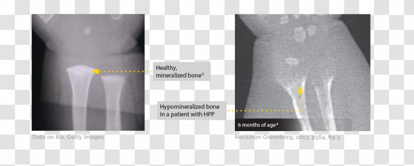 Hypophosphatasia Bone Rickets Osteomalacia Radiology - Disease - Fracture Transparent PNG