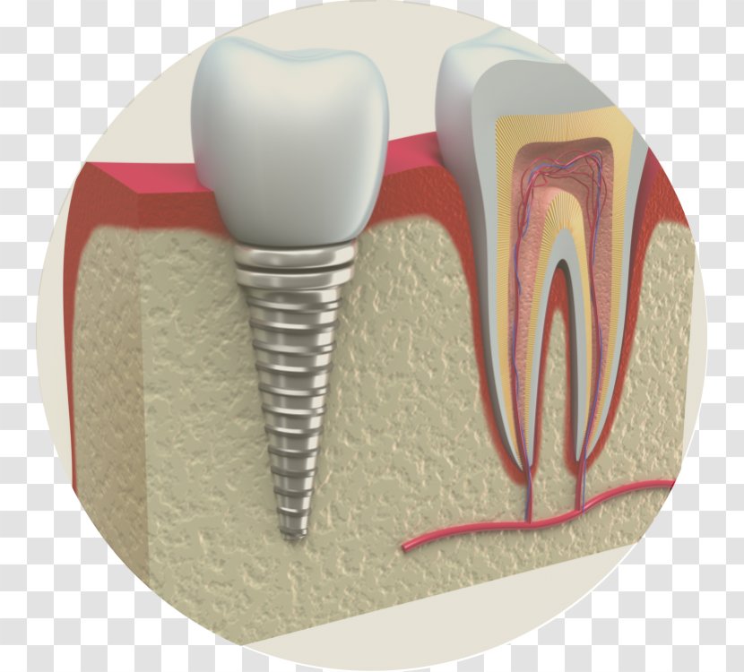 Dental Implant Periodontal Disease Dentistry Periodontology - Silhouette - Crown Transparent PNG