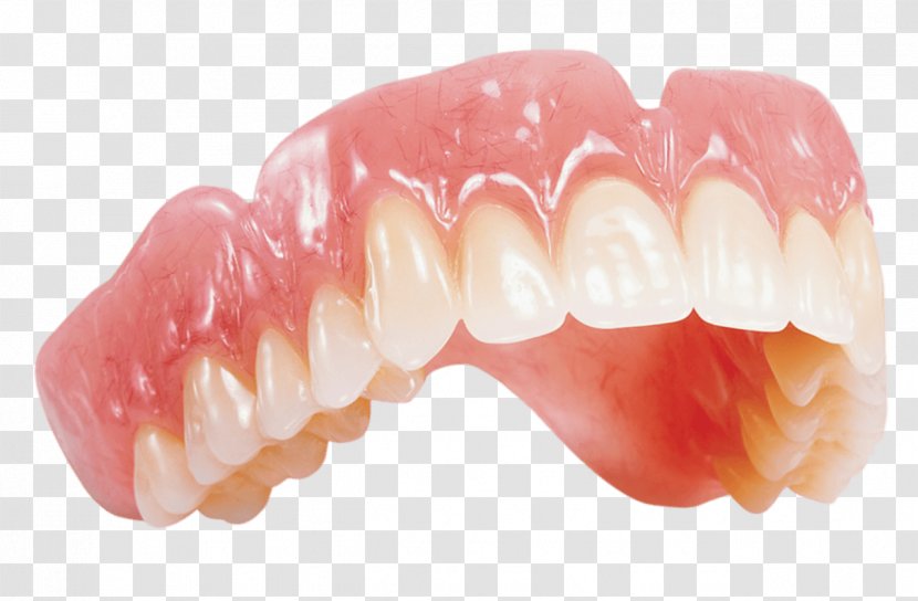 Dentures Removable Partial Denture Dentistry Dental Laboratory Crown - Mouth - Chewing Gum Transparent PNG