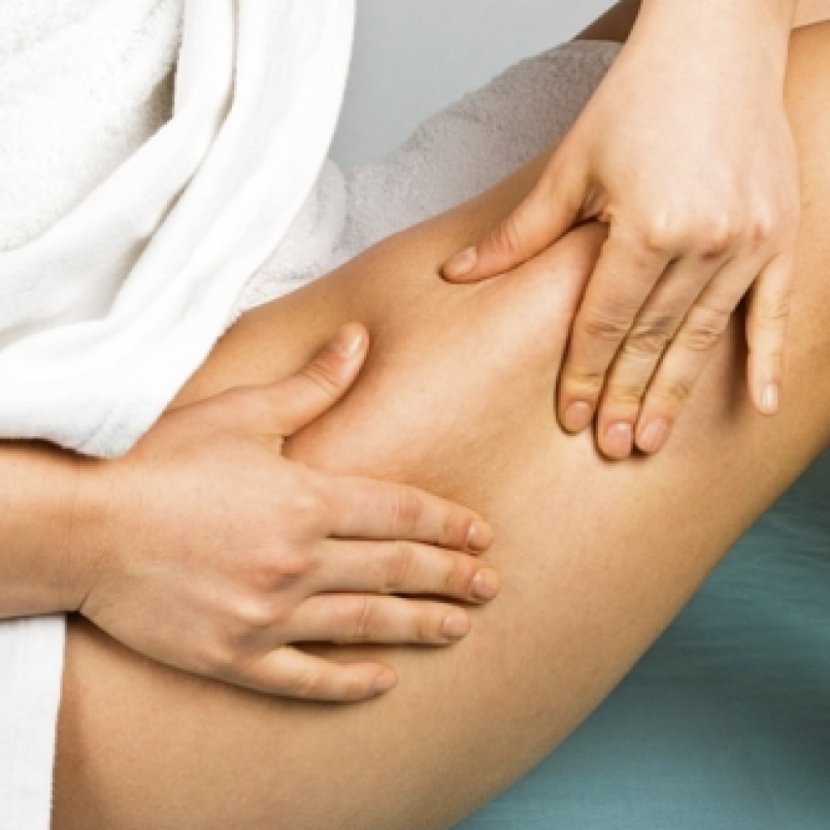 Skin Cancer Symptom Stretch Marks Cellulite - Tree - Massage Transparent PNG