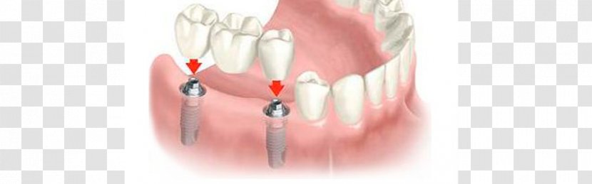 Dental Implant Dentistry Bridge Dentures - Frame Transparent PNG