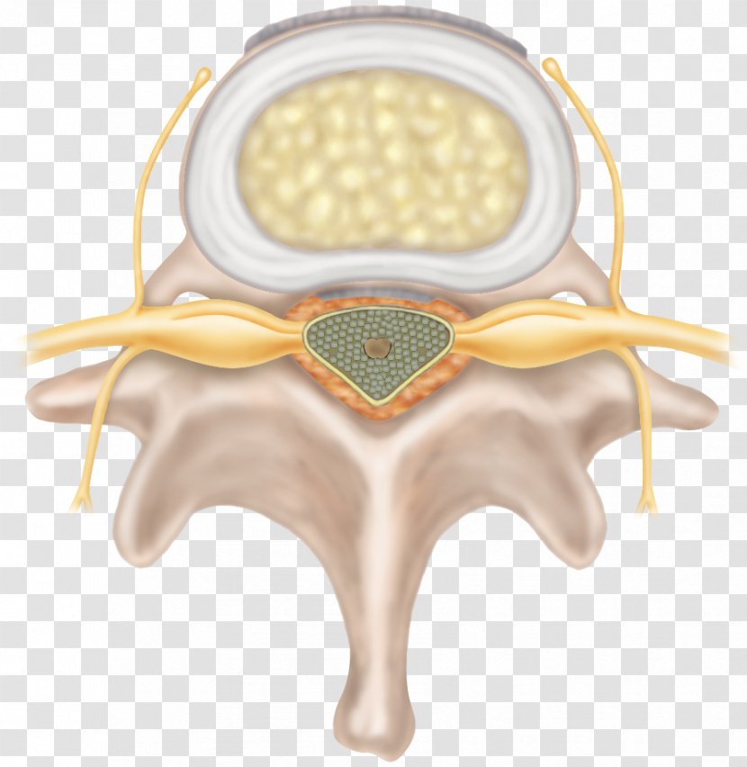 Spinal Disc Herniation Intervertebral Degenerative Disease Cervical Vertebrae Neck Pain - Degenerate Transparent PNG