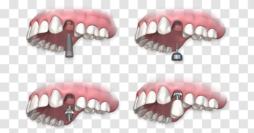 Dental Implant Dentistry Dentures - Nail - Crown Transparent PNG