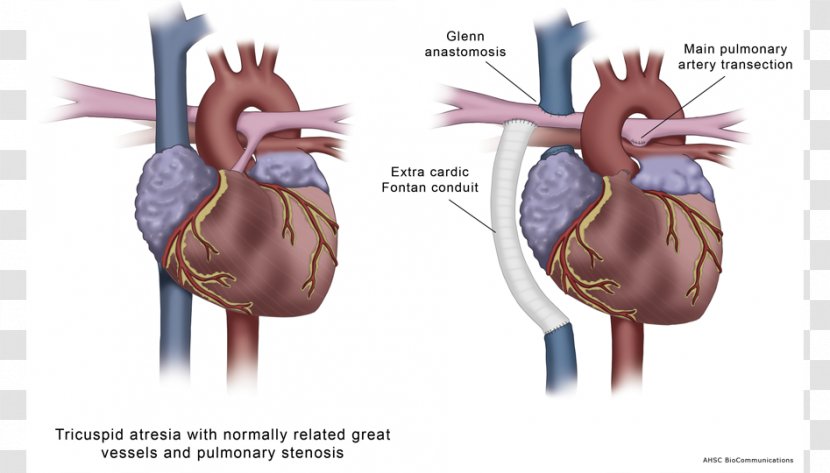 Medical Illustration Medicine Cardiology Atresia - Tree - Heart Transparent PNG