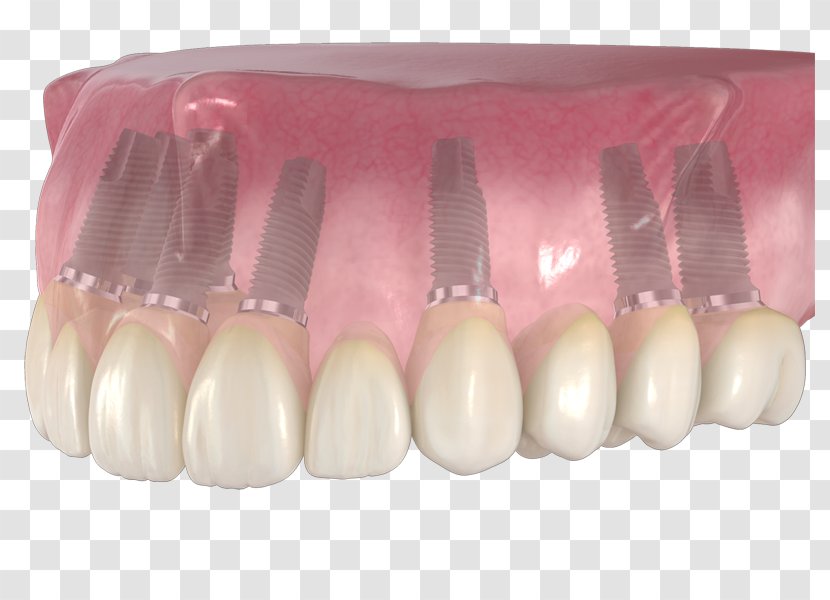Tooth Dentures Prosthesis Head Nail - Mouth - Implant Transparent PNG