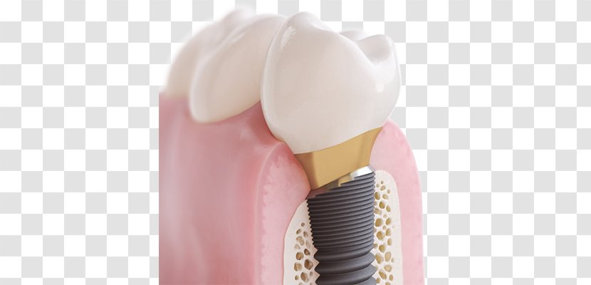 Dental Implant Cosmetic Dentistry Tooth - Oral Hygiene - Crown Transparent PNG