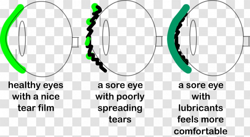 Dry Eye Syndrome Allergy Keratoconjunctivitis Disease - Material Transparent PNG