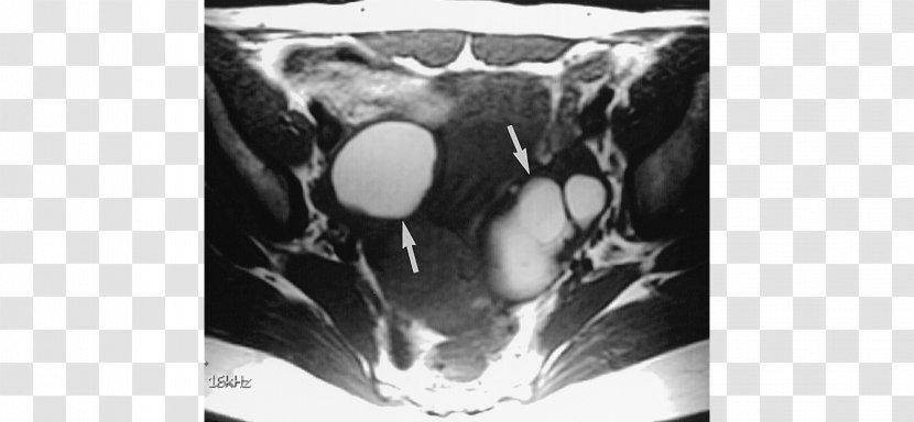Disease Medicine Radiology Phimosis Gynaecology - Monochrome Photography - Joint Transparent PNG