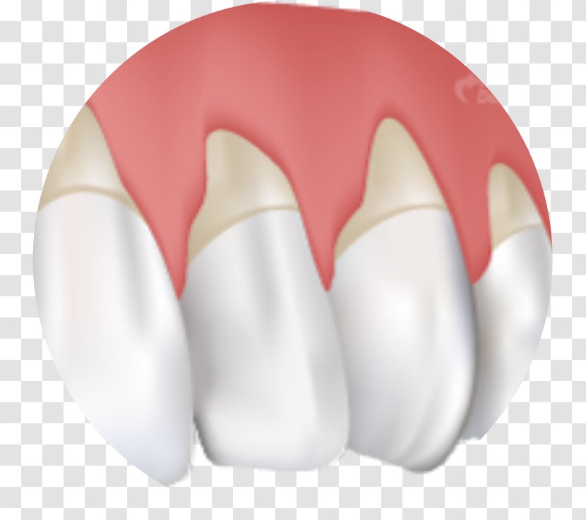 Gums Gingival Recession Gingivitis Periodontal Disease Cure - Dentistry - Health Transparent PNG