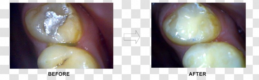 Ceramco Dental Clinic Borivali Dentist Nand Dham Appartments Mouth Jaw - Silhouette - Fill A Tooth Transparent PNG