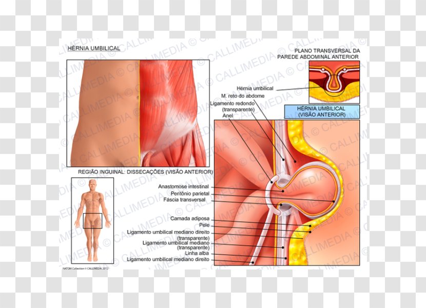 Umbilical Hernia Laparoscopic Inguinal Repair - Silhouette - Belly Button Anatomy Transparent PNG