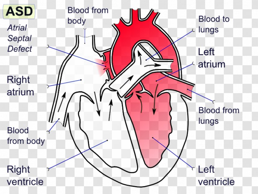 Atrial Septal Defect Ventricular Atrium Interatrial Septum - Watercolor - Heart Transparent PNG